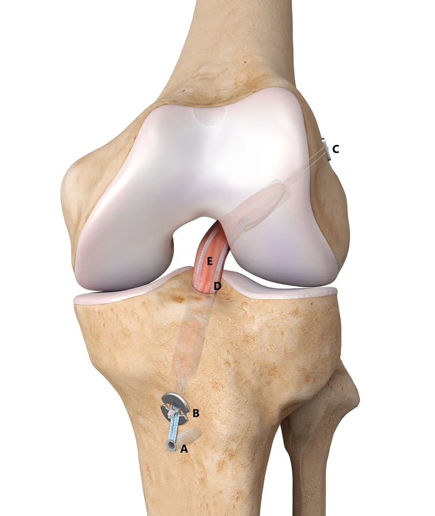 ACL and Ligament Reconstruction - Dr. Tauhid Momen