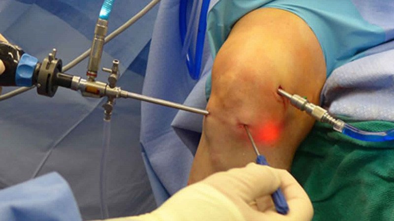 Arthroscopy Treatment - Dr. Tauhid Momen