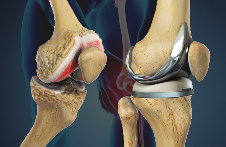 Joint Replacement Surgery - Dr. Tauhid Momen